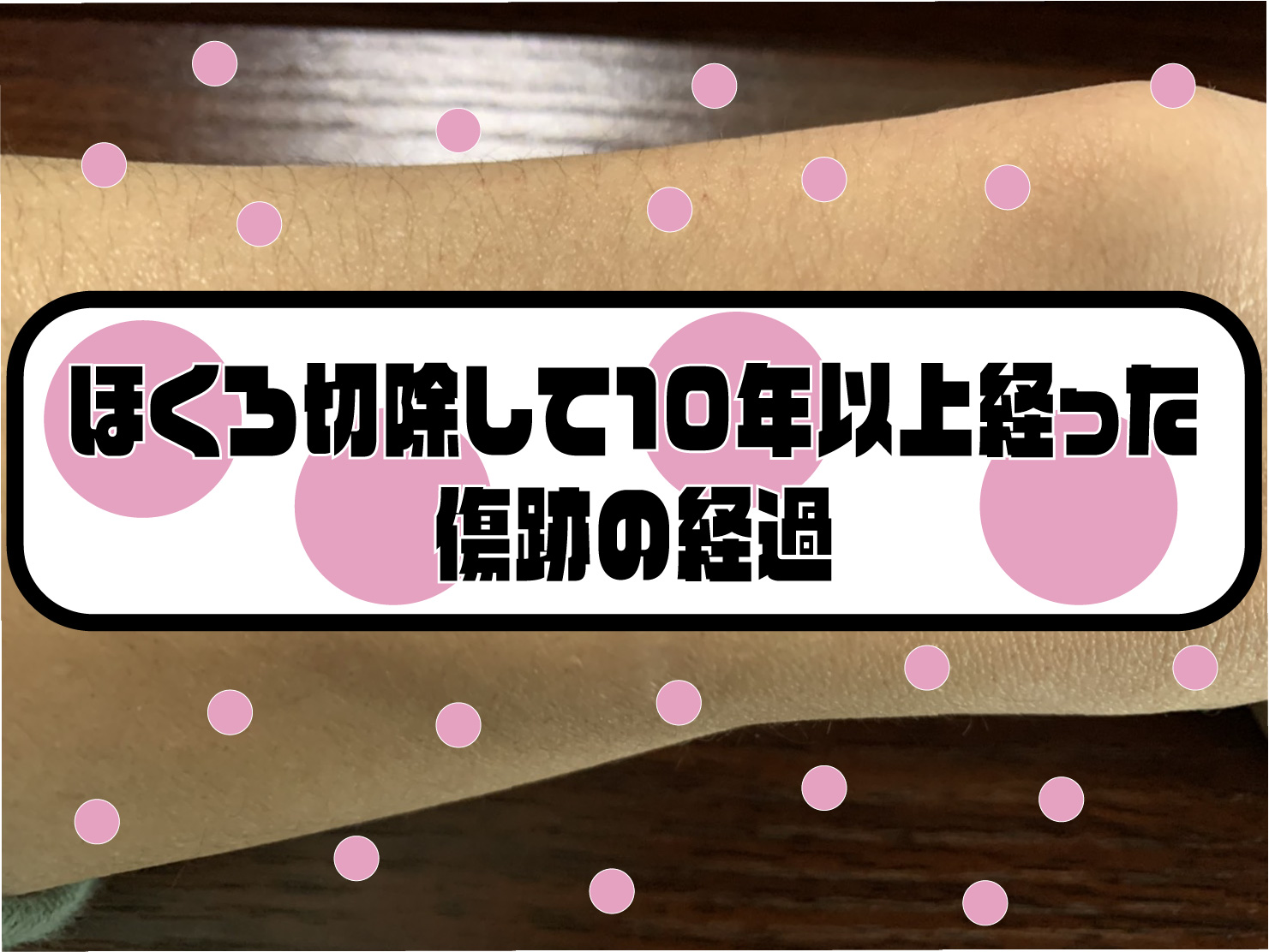 毛が生えるほくろを10年以上前に切除した話と傷跡の経過 Blog To Become Human